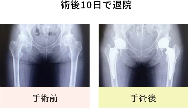 術後10日で退院