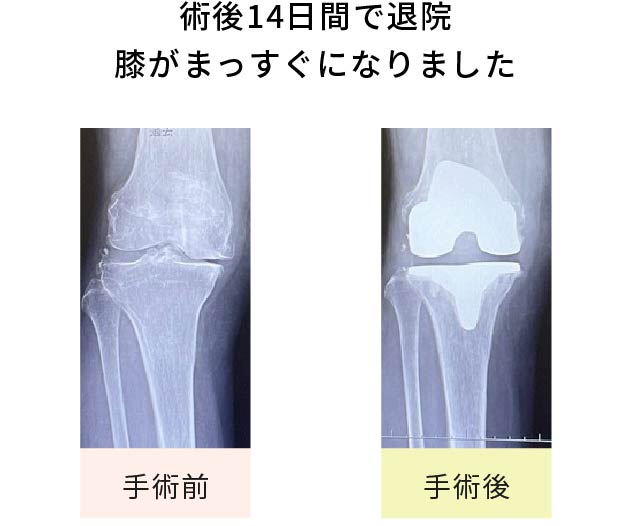 術後14日間で退院。膝がまっすぐになりました