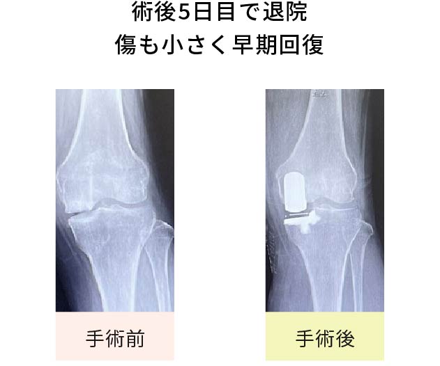 術後5日目で退院。傷も小さく早期回復