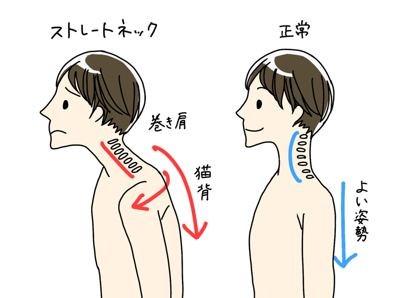 〈健康コラム〉ストレートネック
